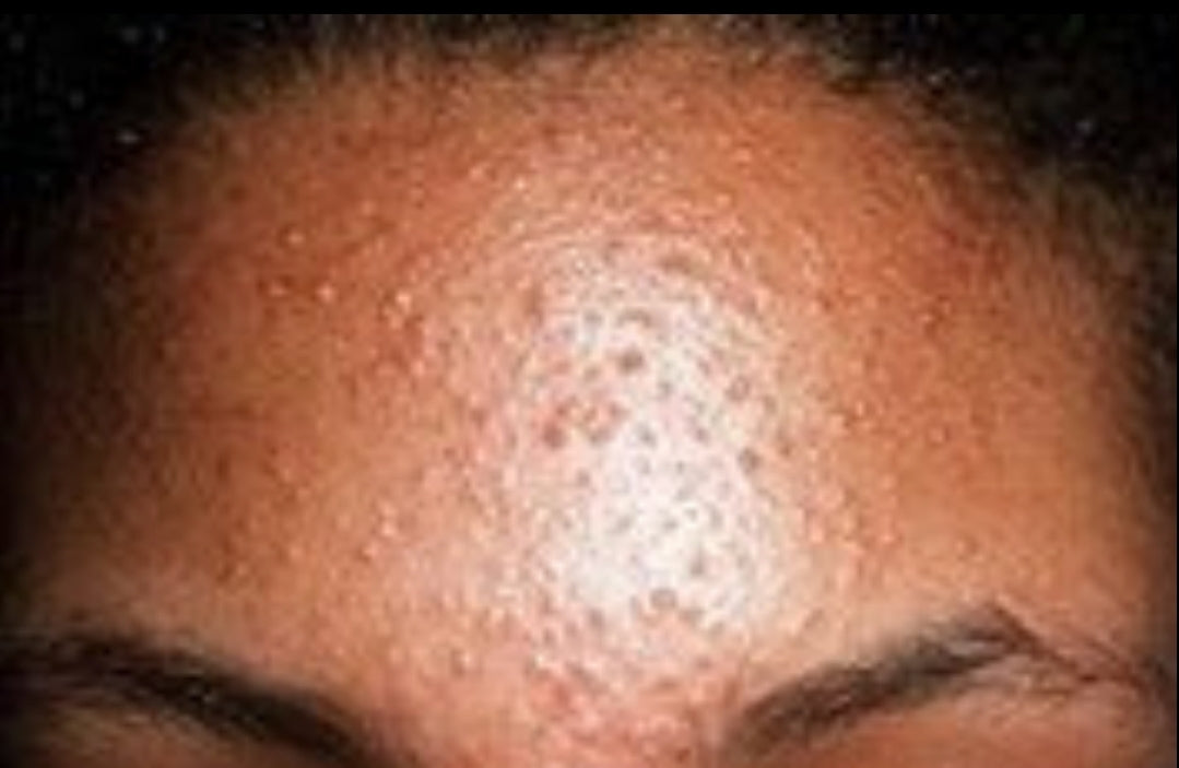 Blemish Control Face and Body Serum