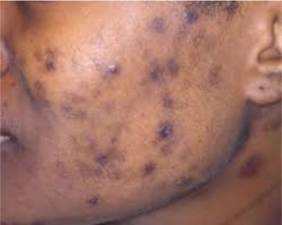 Blemish Control Face and Body Serum