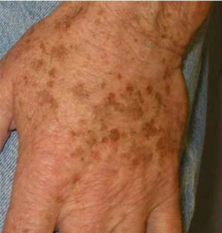 Blemish Control Face and Body Serum